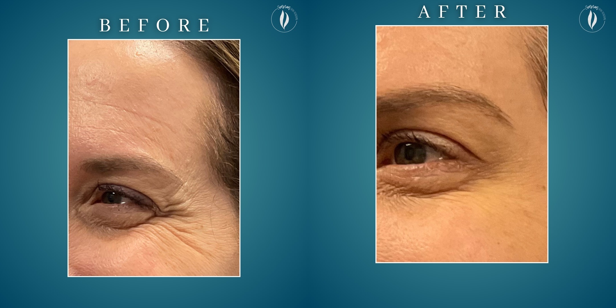 Botox before and after — softened crow’s feet and under-eye crepiness around the eye — Sonoran Skin Renewal, Scottsdale AZ