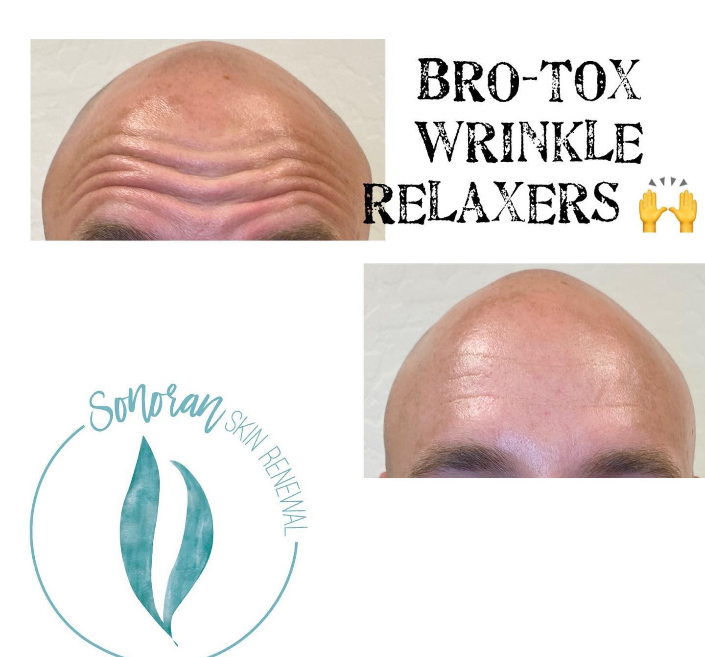 Botox for men before and after — smoother forehead, still masculine — Sonoran Skin Renewal, Scottsdale AZ