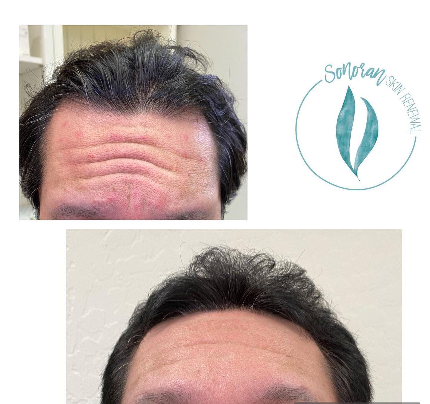 Botox for men before and after — smoother forehead, still masculine — Sonoran Skin Renewal, Scottsdale AZ