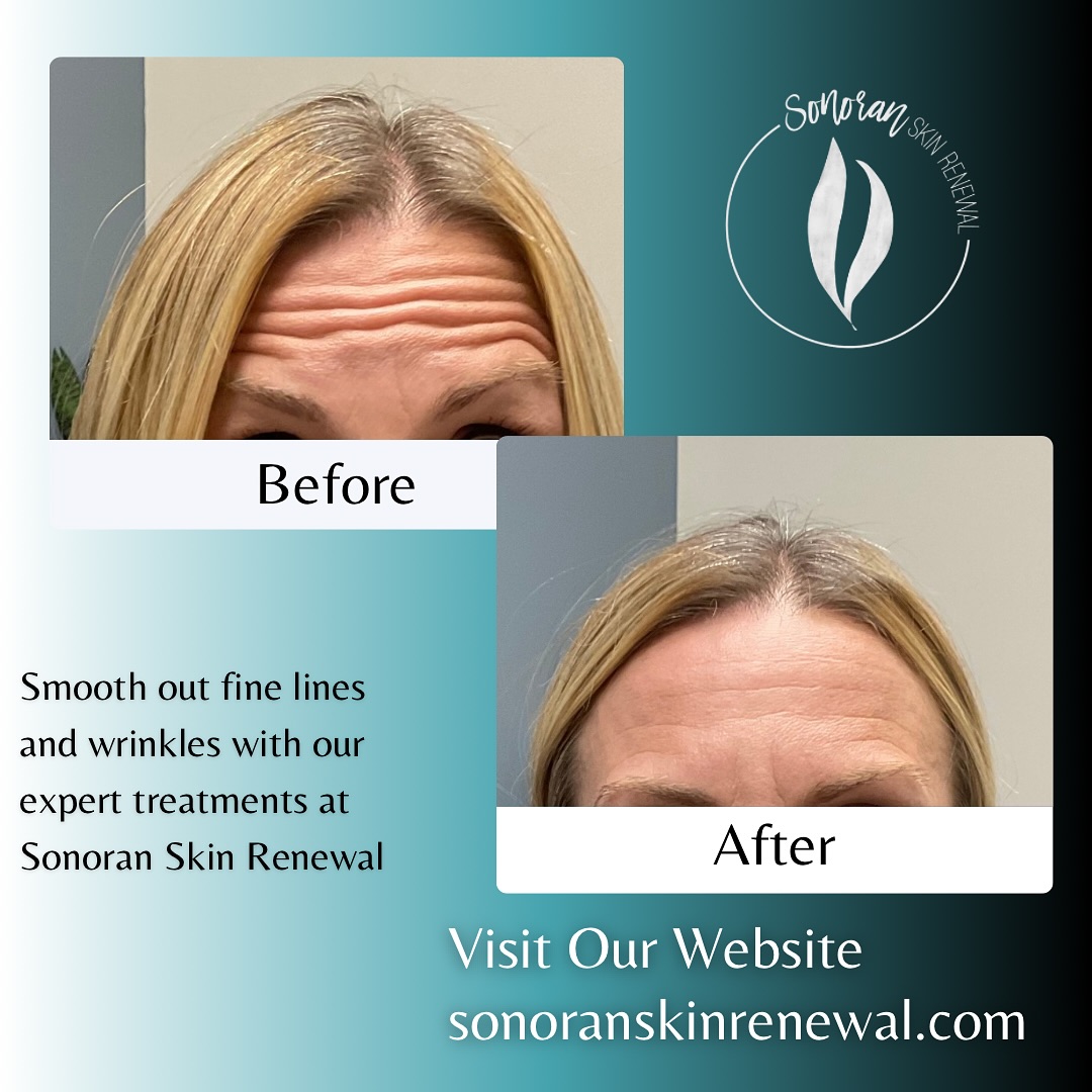 Botox before and after — softened forehead lines and frown lines — Sonoran Skin Renewal, Scottsdale AZ