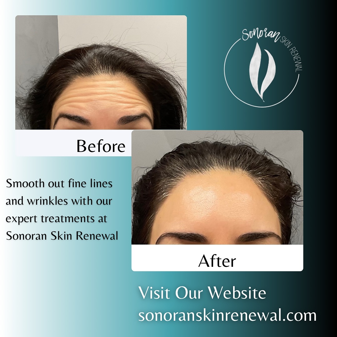 Botox before and after — softened forehead lines and frown lines — Sonoran Skin Renewal, Scottsdale AZ
