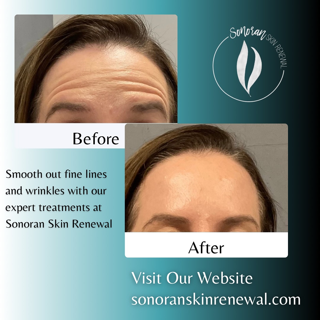 Botox before and after — softened forehead lines and frown lines — Sonoran Skin Renewal, Scottsdale AZ