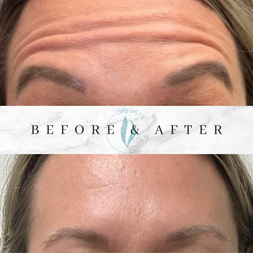 Botox before and after — softened forehead lines and frown lines — Sonoran Skin Renewal, Scottsdale AZ