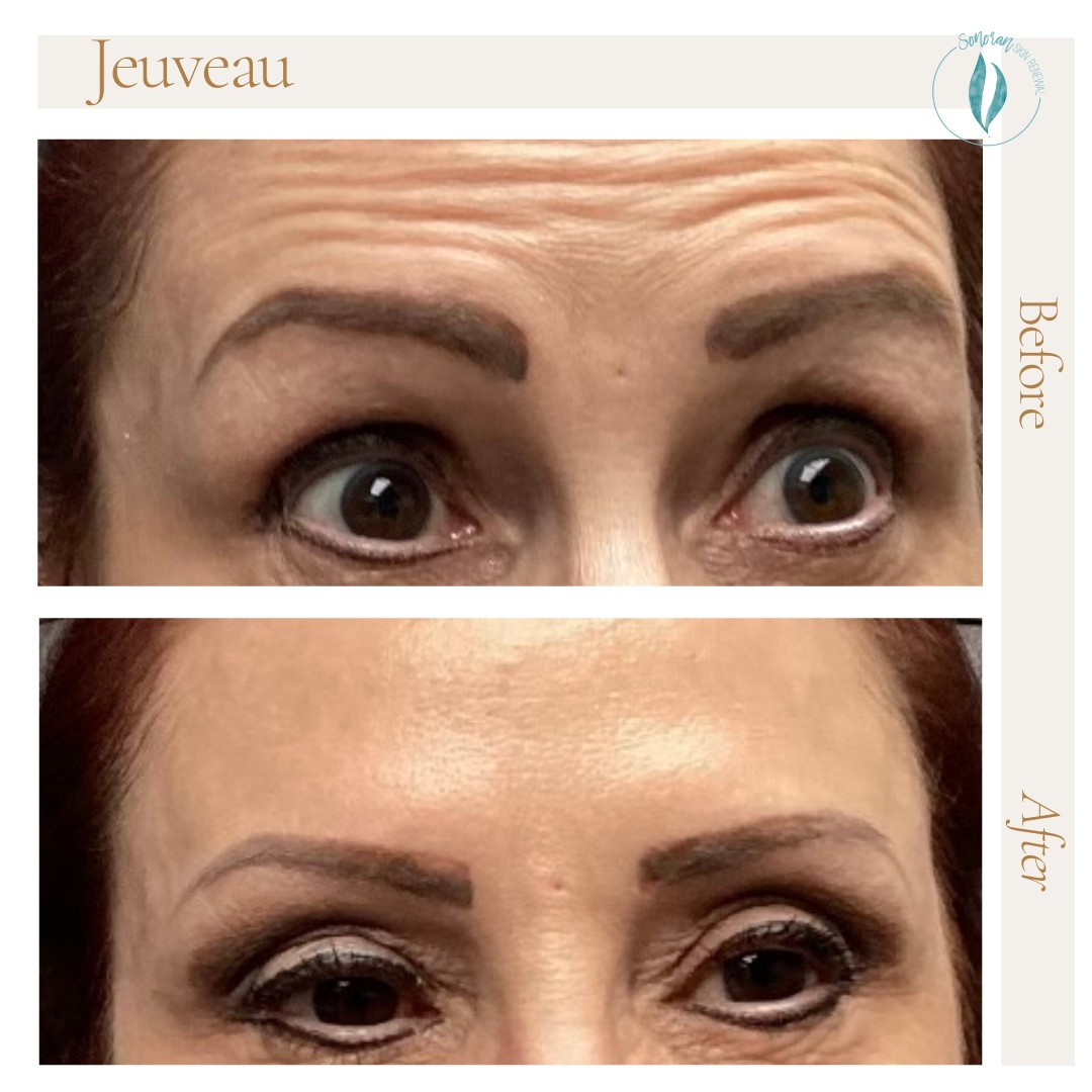 Botox before and after — softened forehead lines and frown lines — Sonoran Skin Renewal, Scottsdale AZ