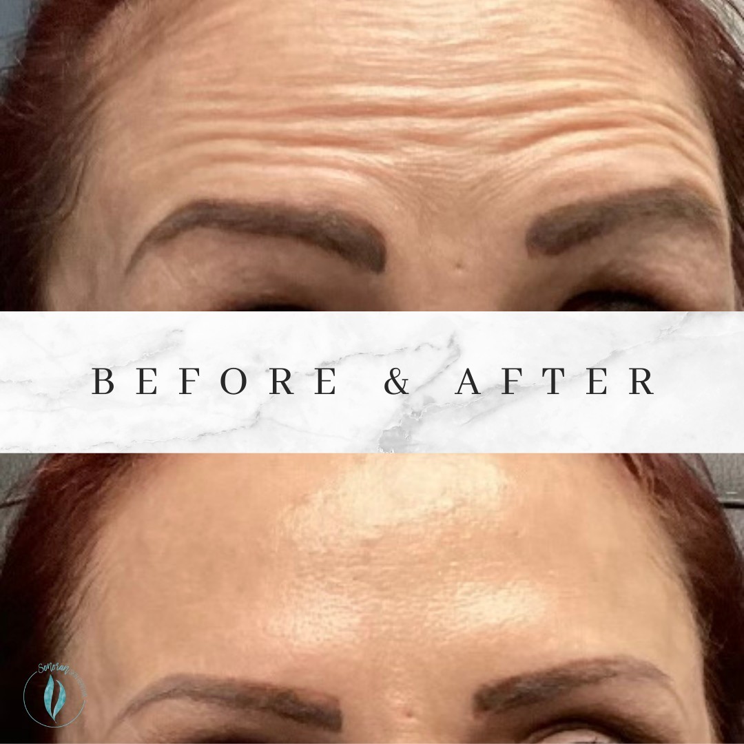 Botox before and after — softened forehead lines and frown lines — Sonoran Skin Renewal, Scottsdale AZ