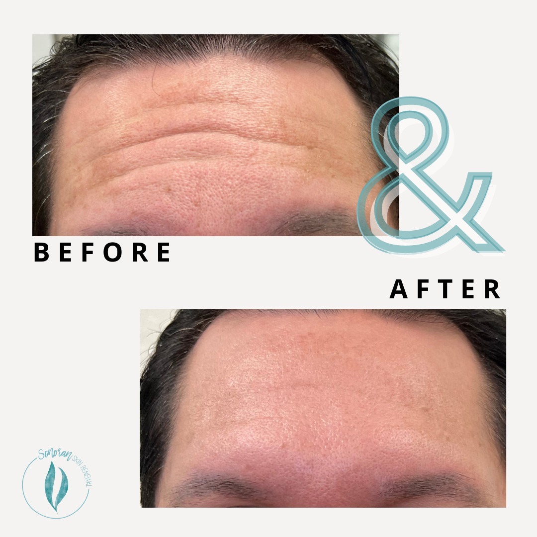 Botox before and after — softened forehead lines and frown lines — Sonoran Skin Renewal, Scottsdale AZ
