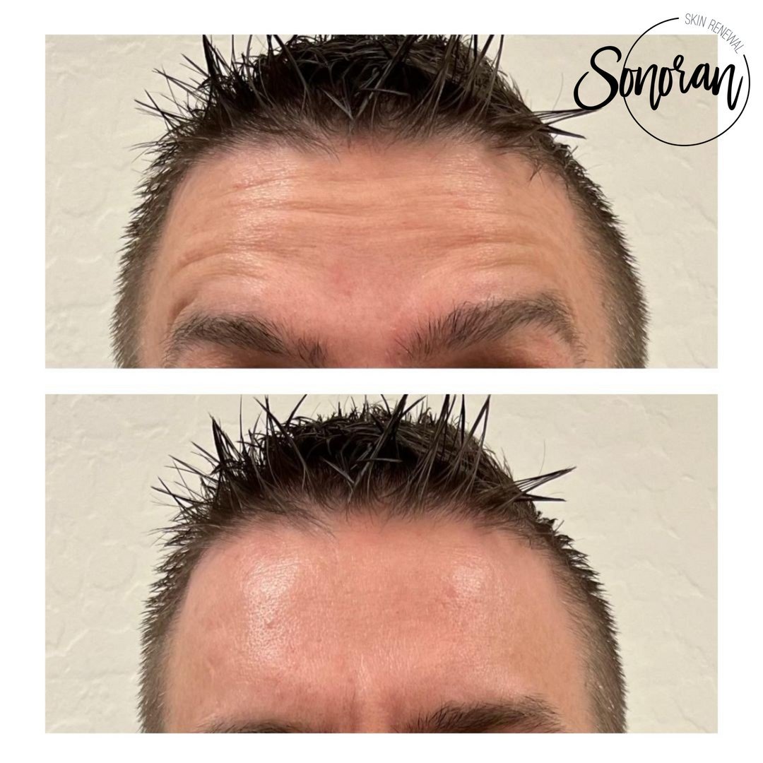 Botox before and after — softened forehead lines and frown lines — Sonoran Skin Renewal, Scottsdale AZ