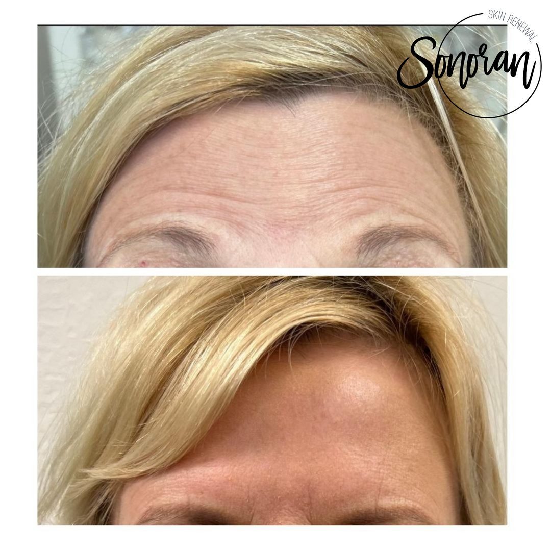 Botox before and after — softened forehead lines and frown lines — Sonoran Skin Renewal, Scottsdale AZ