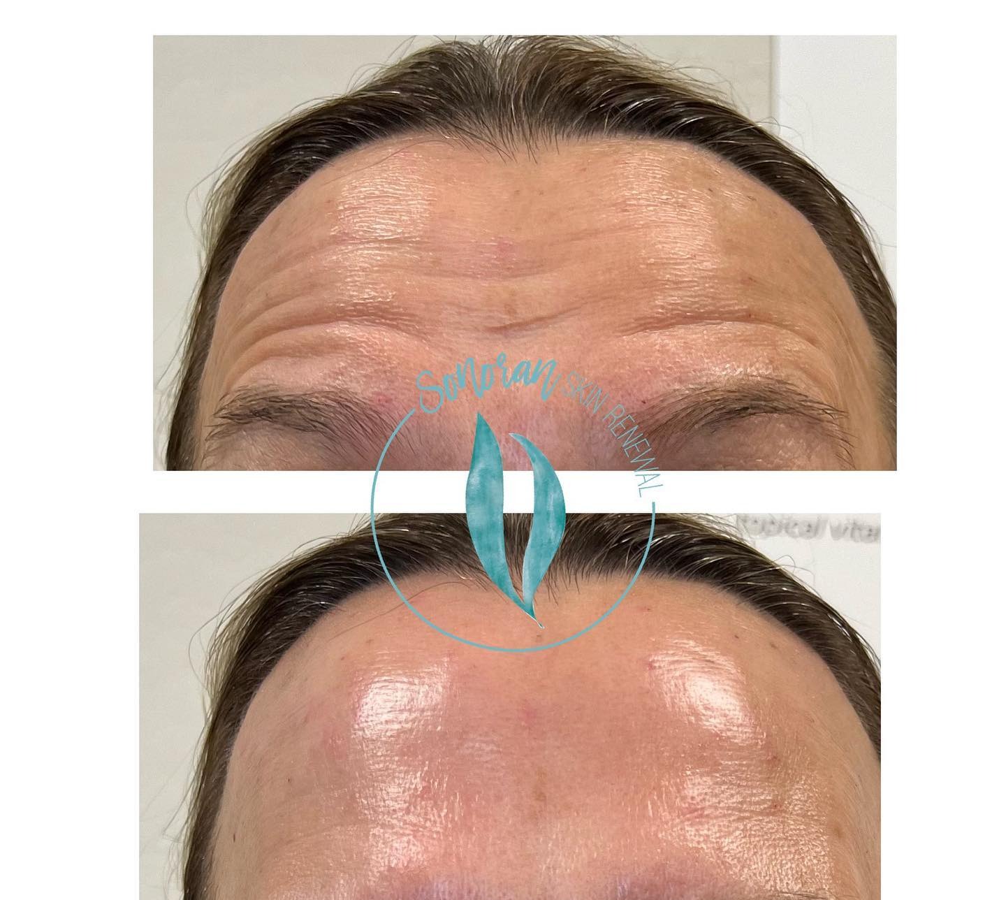 Botox before and after — softened forehead lines and frown lines — Sonoran Skin Renewal, Scottsdale AZ