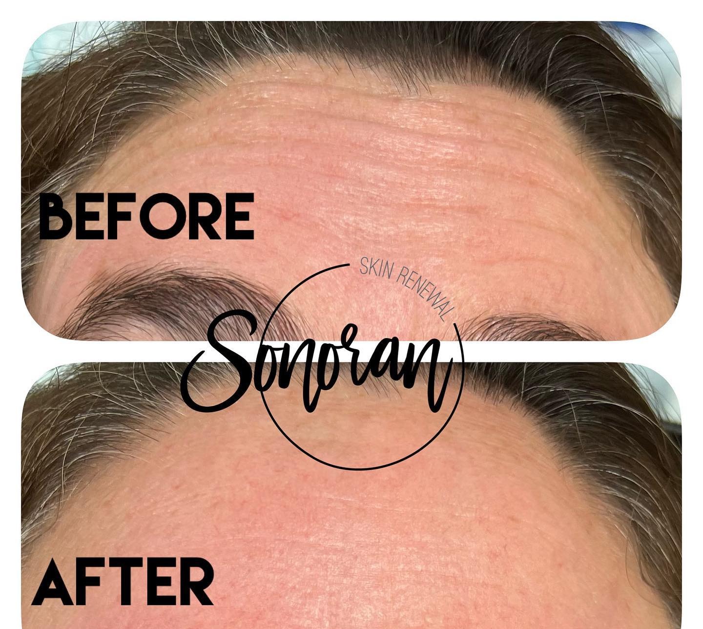 Botox before and after — softened forehead lines and frown lines — Sonoran Skin Renewal, Scottsdale AZ