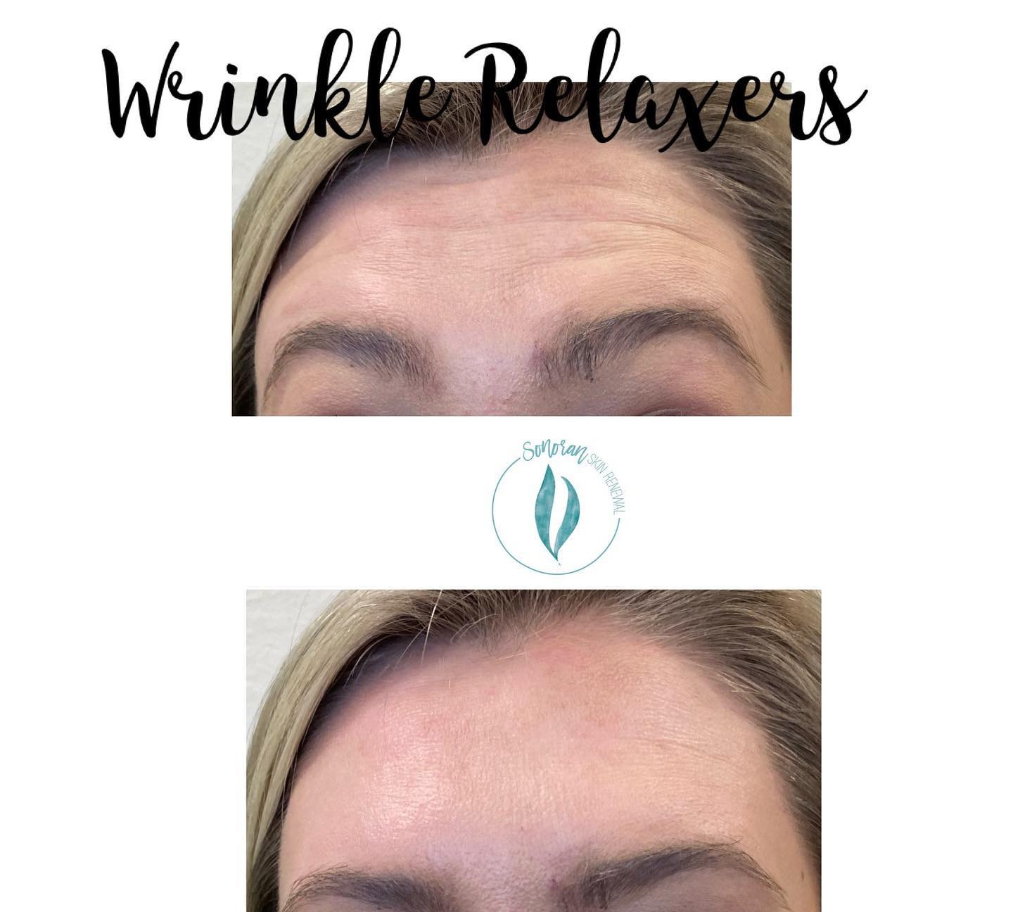 Botox before and after — softened forehead lines and frown lines — Sonoran Skin Renewal, Scottsdale AZ