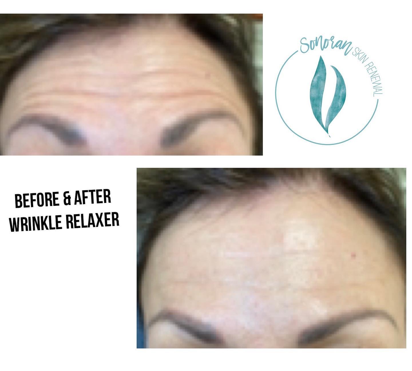 Botox before and after — softened forehead lines and frown lines — Sonoran Skin Renewal, Scottsdale AZ