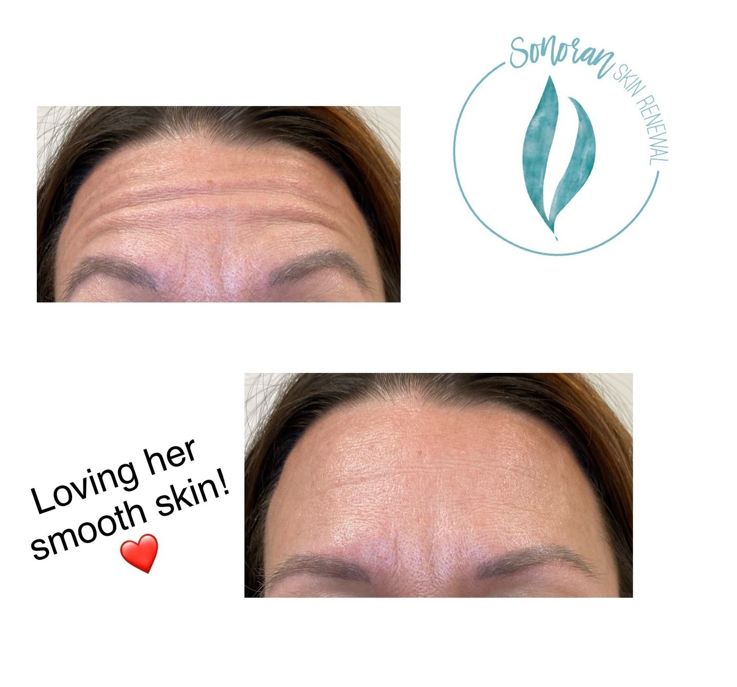 Botox before and after — softened forehead lines and frown lines — Sonoran Skin Renewal, Scottsdale AZ