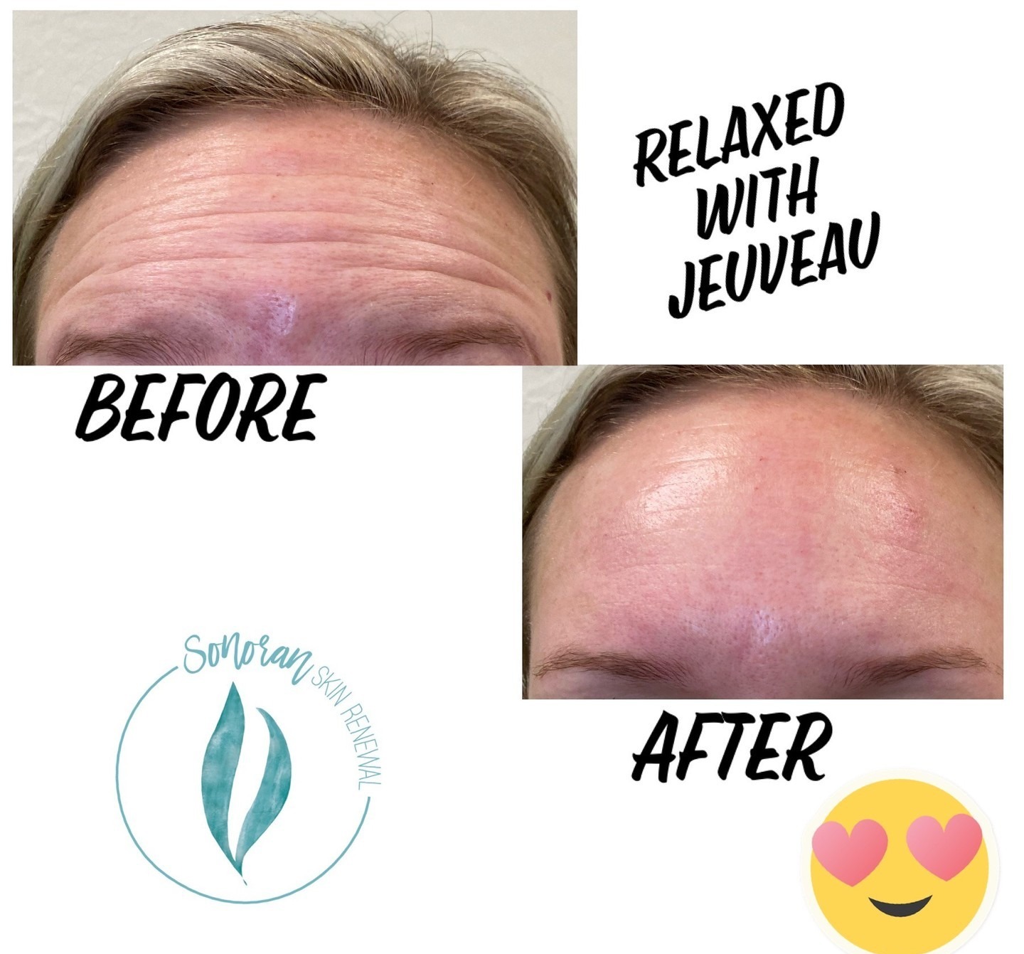 Botox before and after — softened forehead lines and frown lines — Sonoran Skin Renewal, Scottsdale AZ