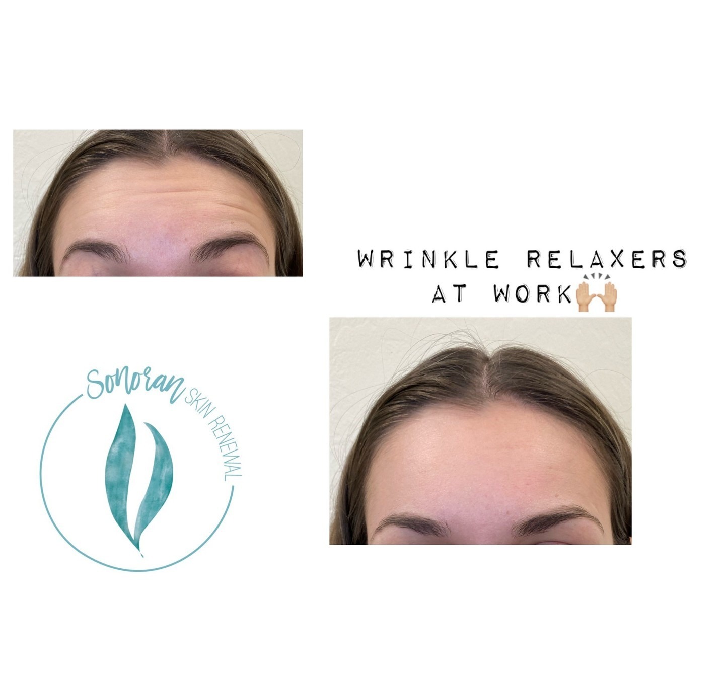 Botox before and after — softened forehead lines and frown lines — Sonoran Skin Renewal, Scottsdale AZ