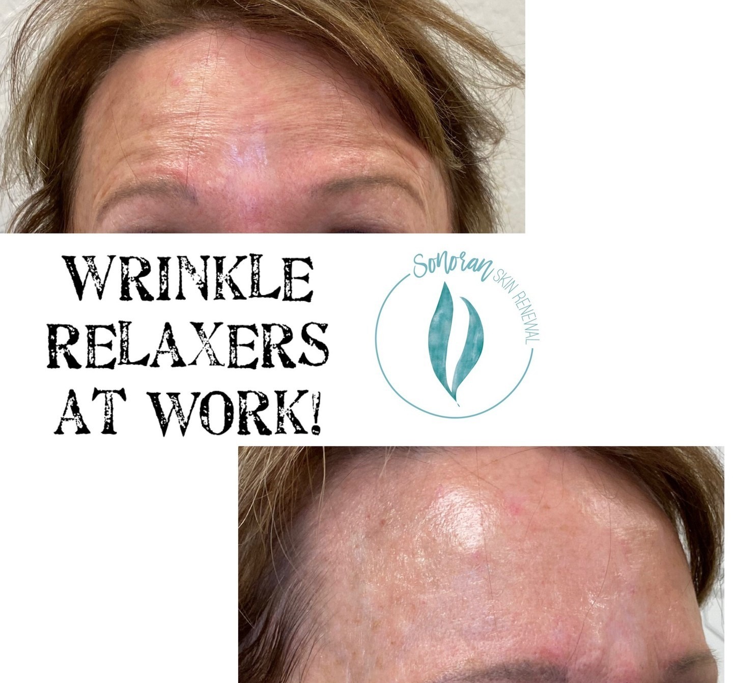 Botox before and after — softened forehead lines and frown lines — Sonoran Skin Renewal, Scottsdale AZ
