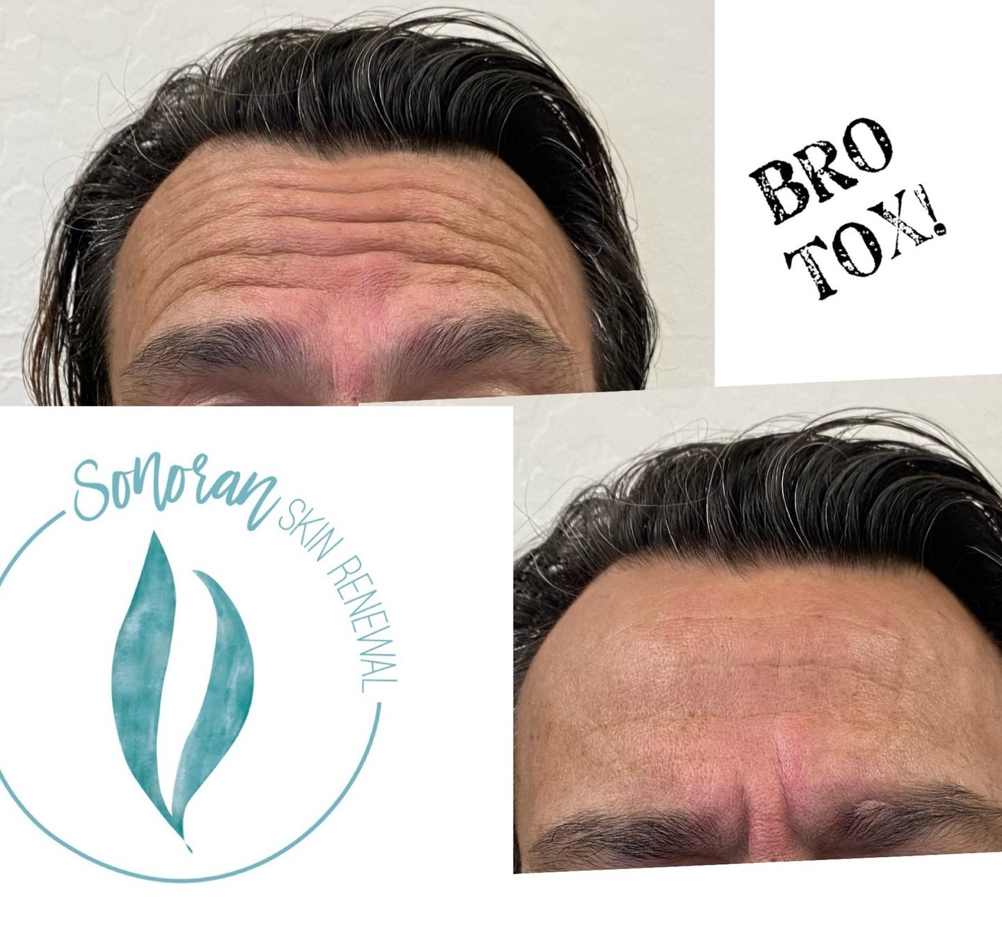 Botox before and after — softened forehead lines and frown lines — Sonoran Skin Renewal, Scottsdale AZ