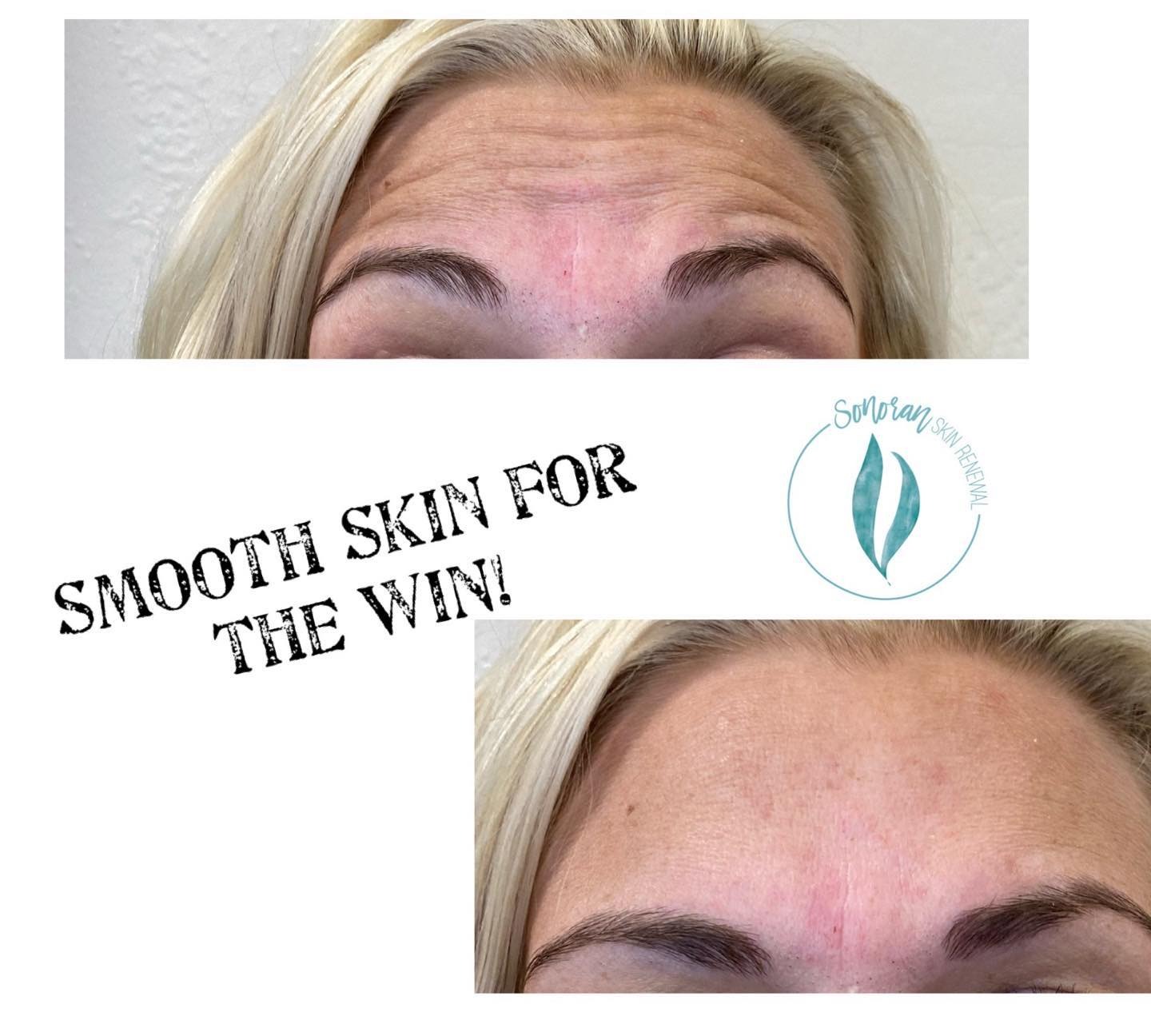 Botox before and after — softened forehead lines and frown lines — Sonoran Skin Renewal, Scottsdale AZ