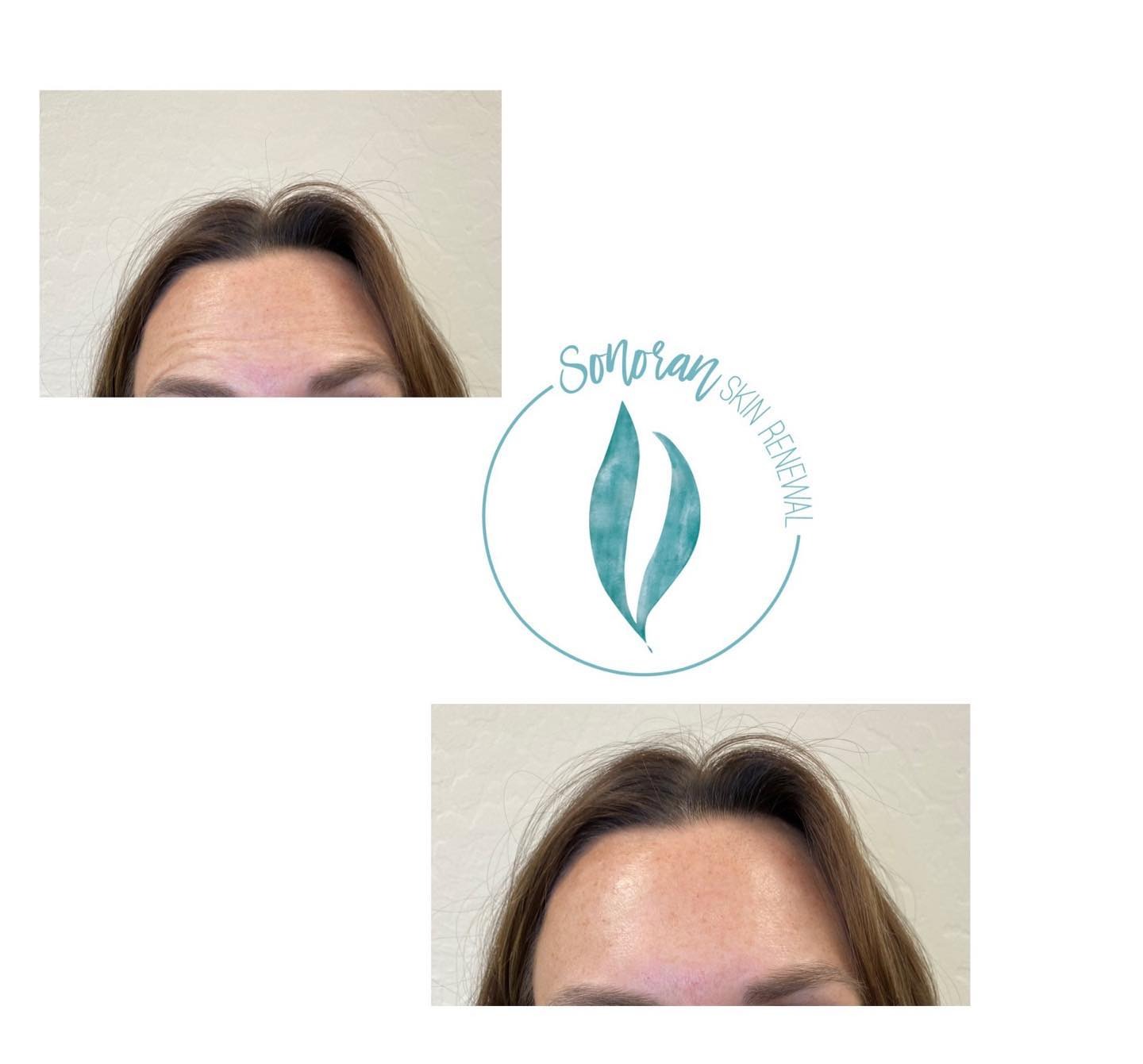 Botox before and after — softened forehead lines and frown lines — Sonoran Skin Renewal, Scottsdale AZ