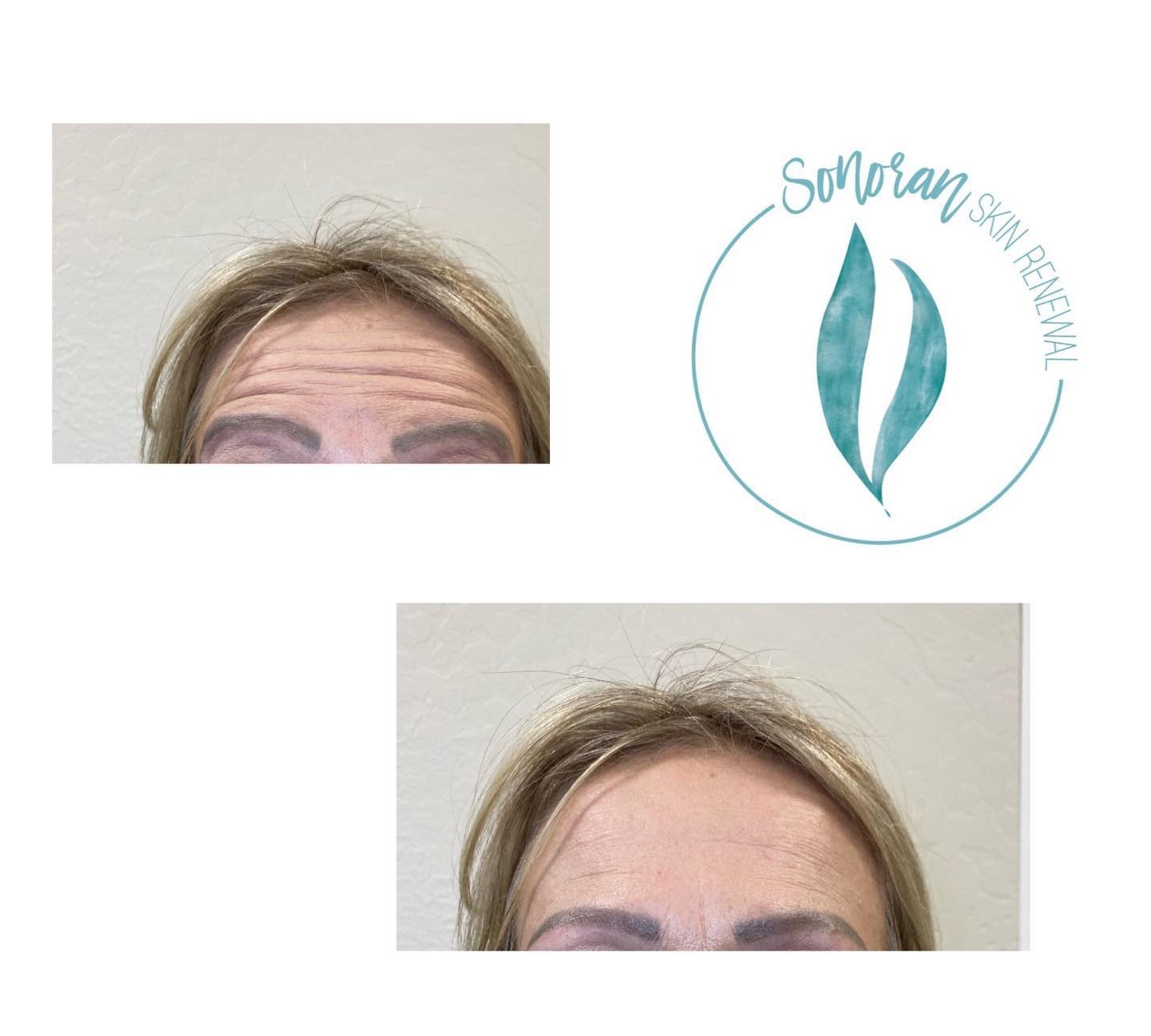 Botox before and after — softened forehead lines and frown lines — Sonoran Skin Renewal, Scottsdale AZ