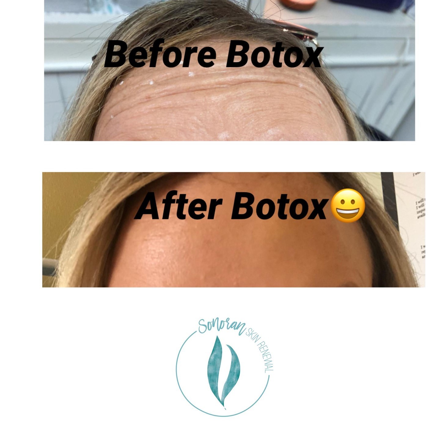 Botox before and after — softened forehead lines and frown lines — Sonoran Skin Renewal, Scottsdale AZ