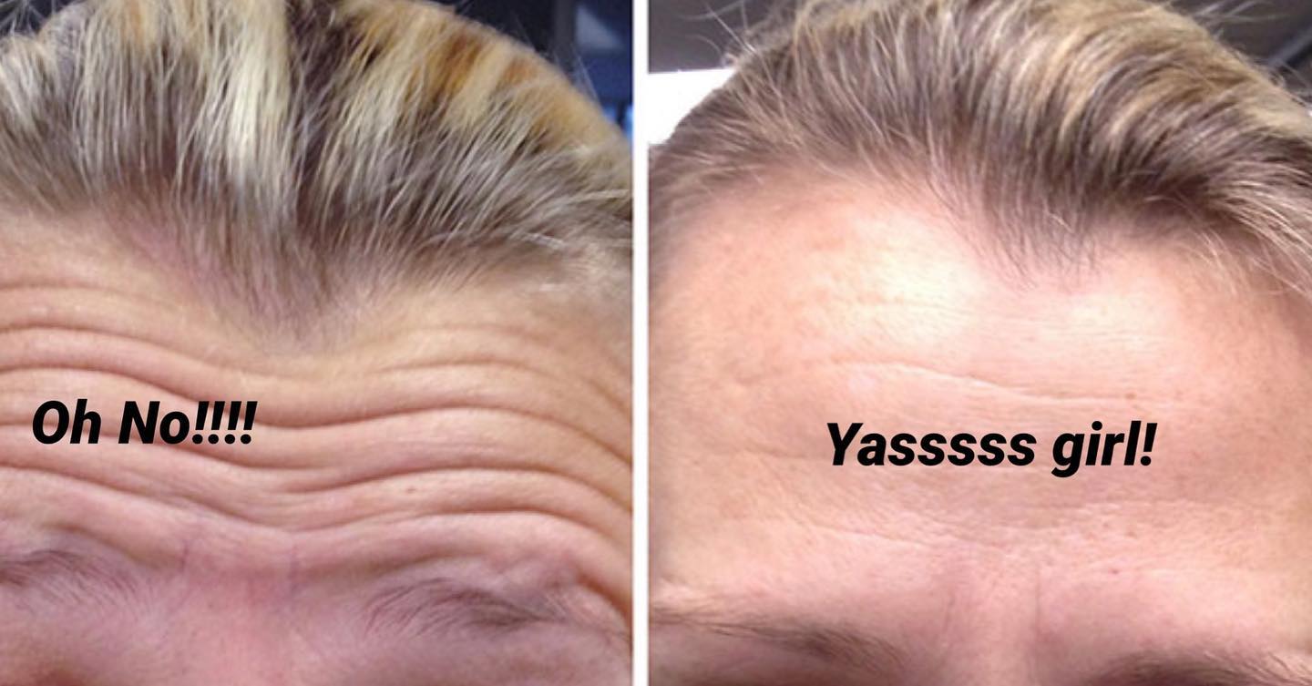 Botox before and after — softened forehead lines and frown lines — Sonoran Skin Renewal, Scottsdale AZ