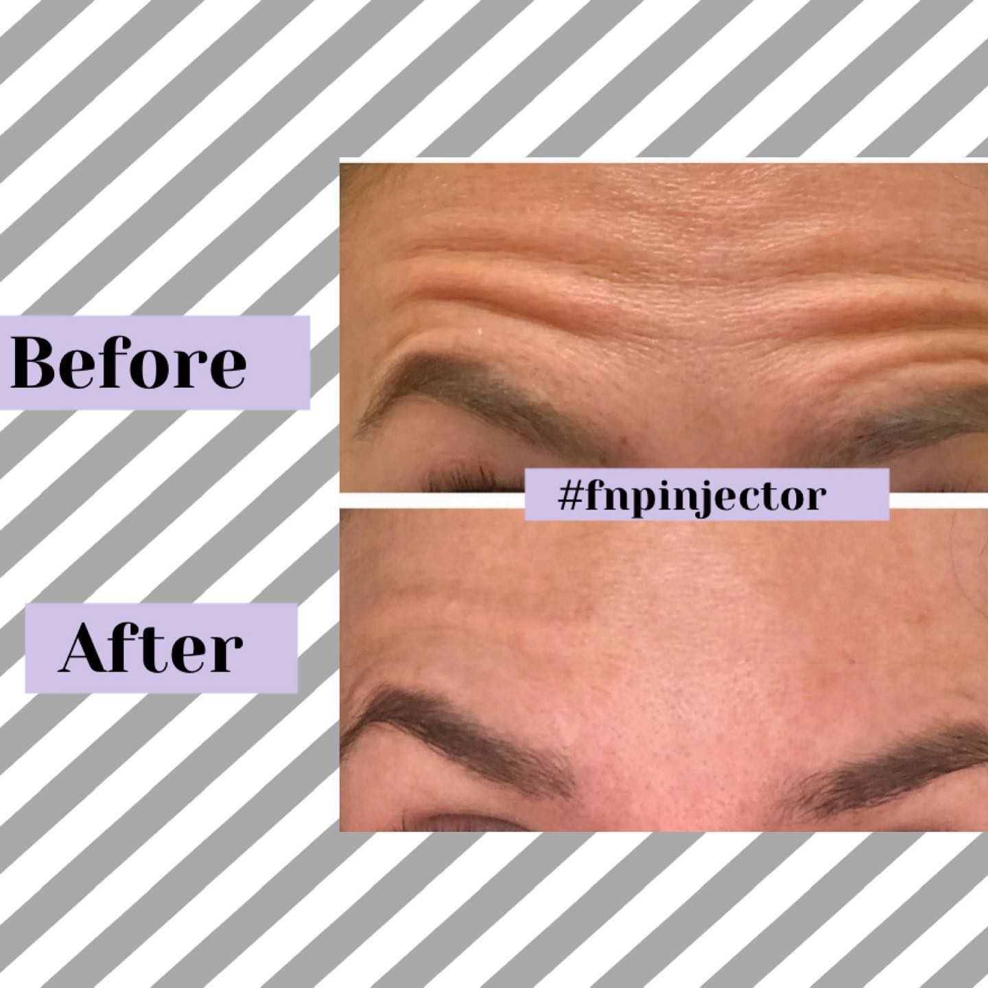 Botox before and after — softened forehead lines and frown lines — Sonoran Skin Renewal, Scottsdale AZ