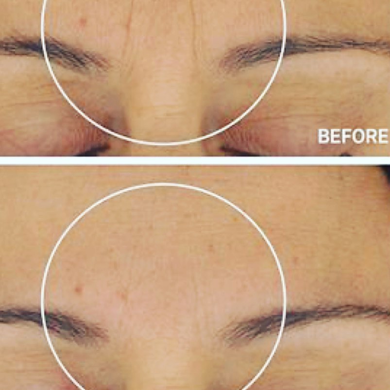 Botox before and after — softened forehead lines and frown lines — Sonoran Skin Renewal, Scottsdale AZ
