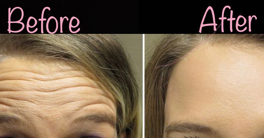 Botox before and after — softened forehead lines and frown lines — Sonoran Skin Renewal, Scottsdale AZ