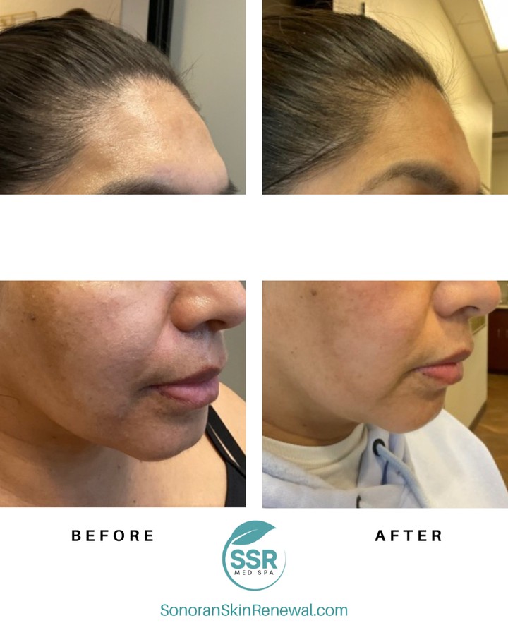 CO2 laser resurfacing before and after — smoother texture and even tone — Sonoran Skin Renewal, Scottsdale AZ