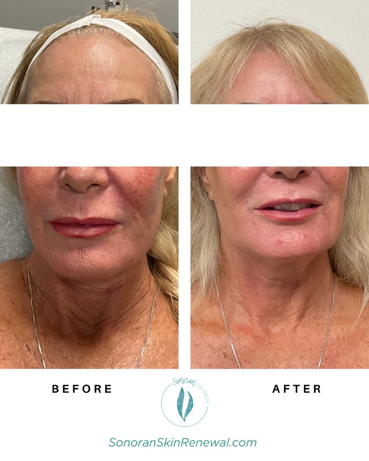 CO2 laser resurfacing before and after — smoother texture and even tone — Sonoran Skin Renewal, Scottsdale AZ