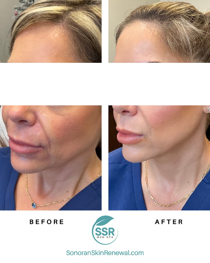 Dermal filler before and after — restored midface volume and structure — Sonoran Skin Renewal, Scottsdale AZ