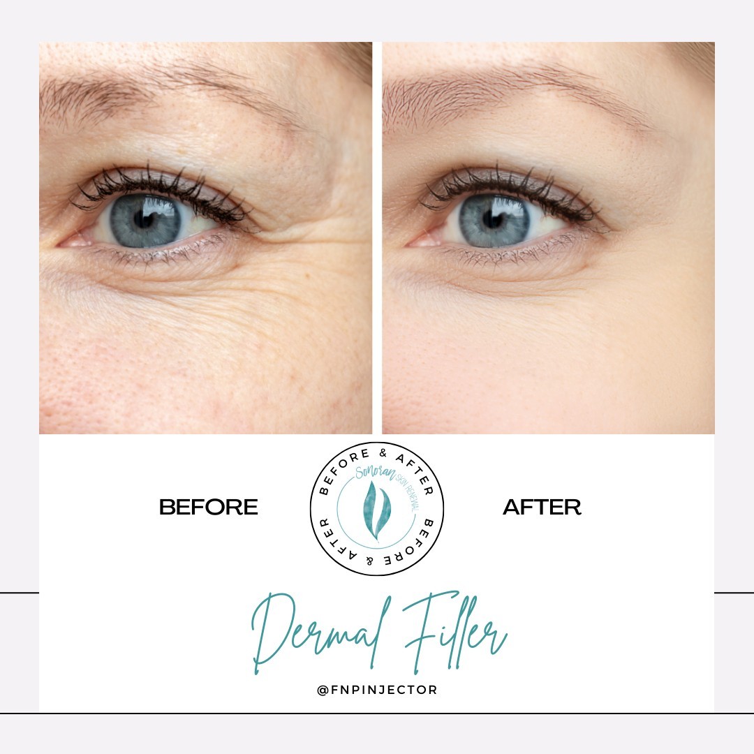 Dermal filler before and after — restored midface volume and structure — Sonoran Skin Renewal, Scottsdale AZ