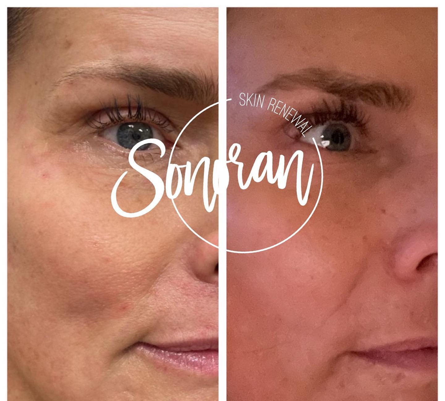 Dermal filler before and after — restored midface volume and structure — Sonoran Skin Renewal, Scottsdale AZ