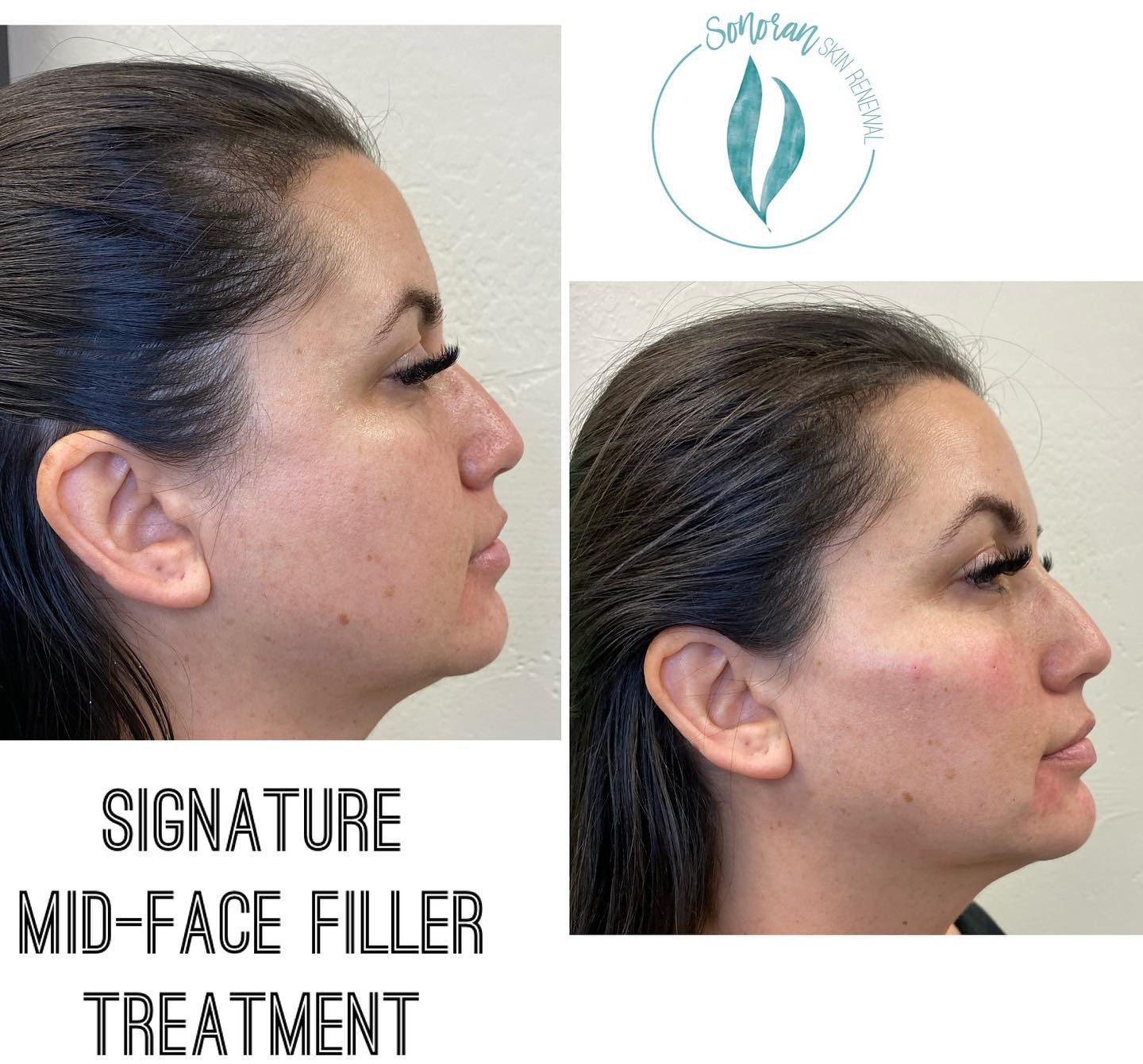 Dermal filler before and after — restored midface volume and structure — Sonoran Skin Renewal, Scottsdale AZ