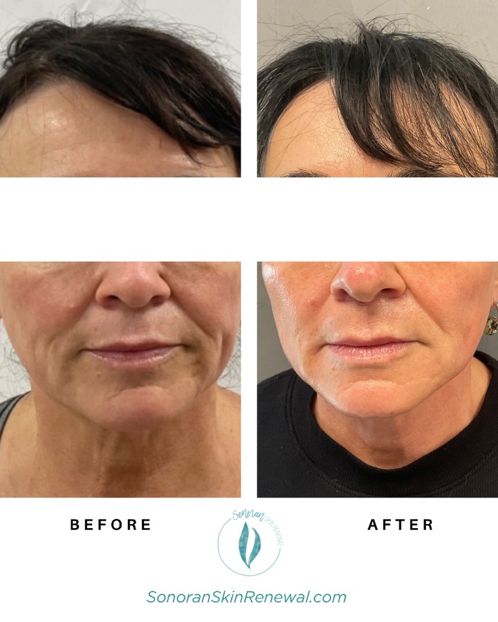 Full facial rejuvenation before and after — restored volume and smoother skin — Sonoran Skin Renewal, Scottsdale AZ