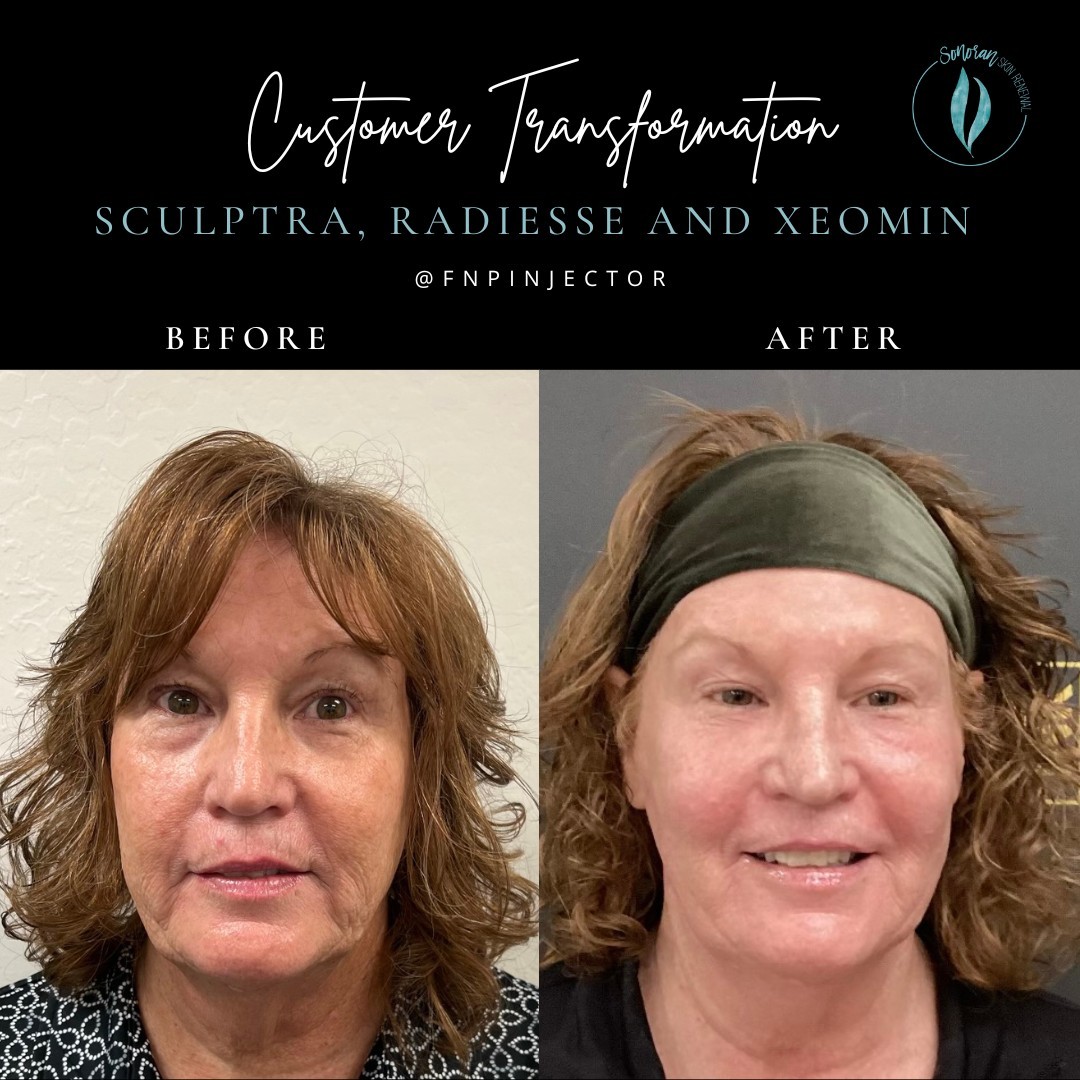 Full facial rejuvenation before and after — restored volume and smoother skin — Sonoran Skin Renewal, Scottsdale AZ
