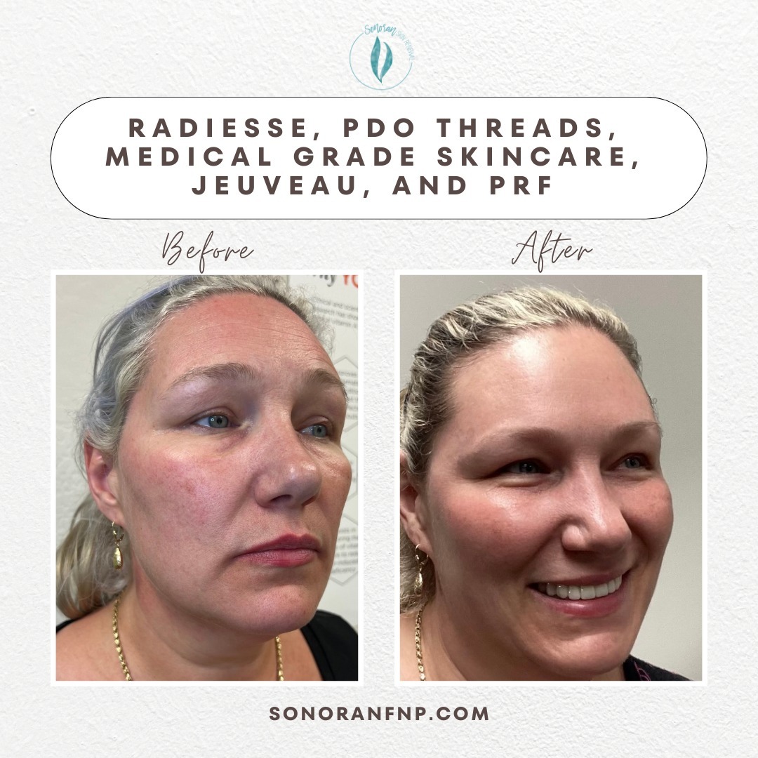 Full facial rejuvenation before and after — restored volume and smoother skin — Sonoran Skin Renewal, Scottsdale AZ