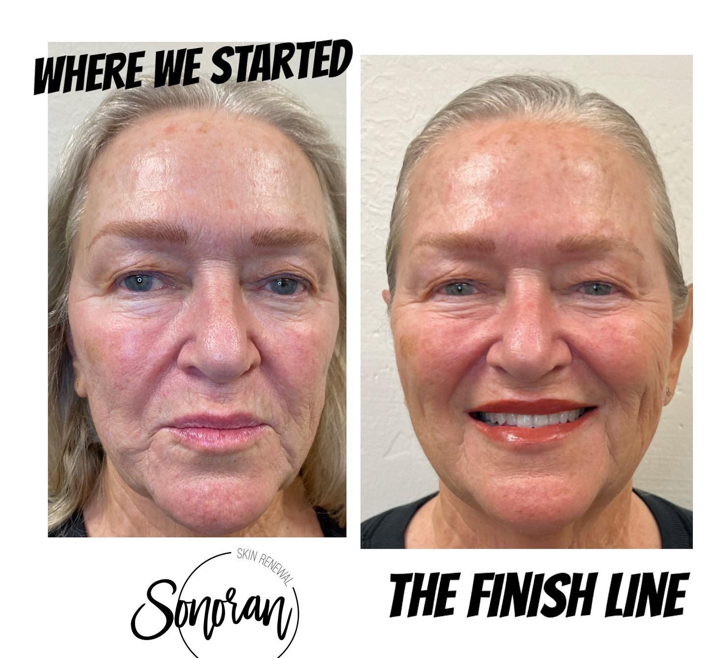Full facial rejuvenation before and after — restored volume and smoother skin — Sonoran Skin Renewal, Scottsdale AZ