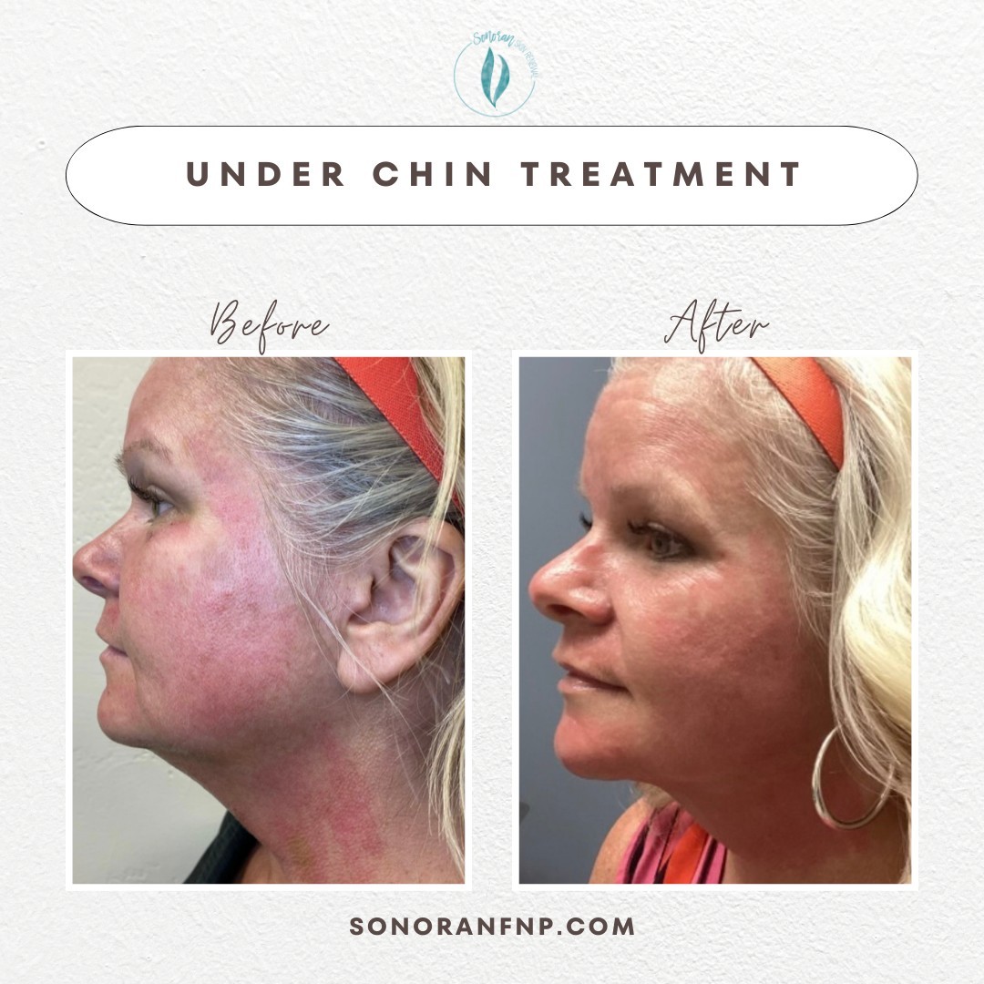 Kybella before and after — reduced submental fullness, sharper jawline — Sonoran Skin Renewal, Scottsdale AZ