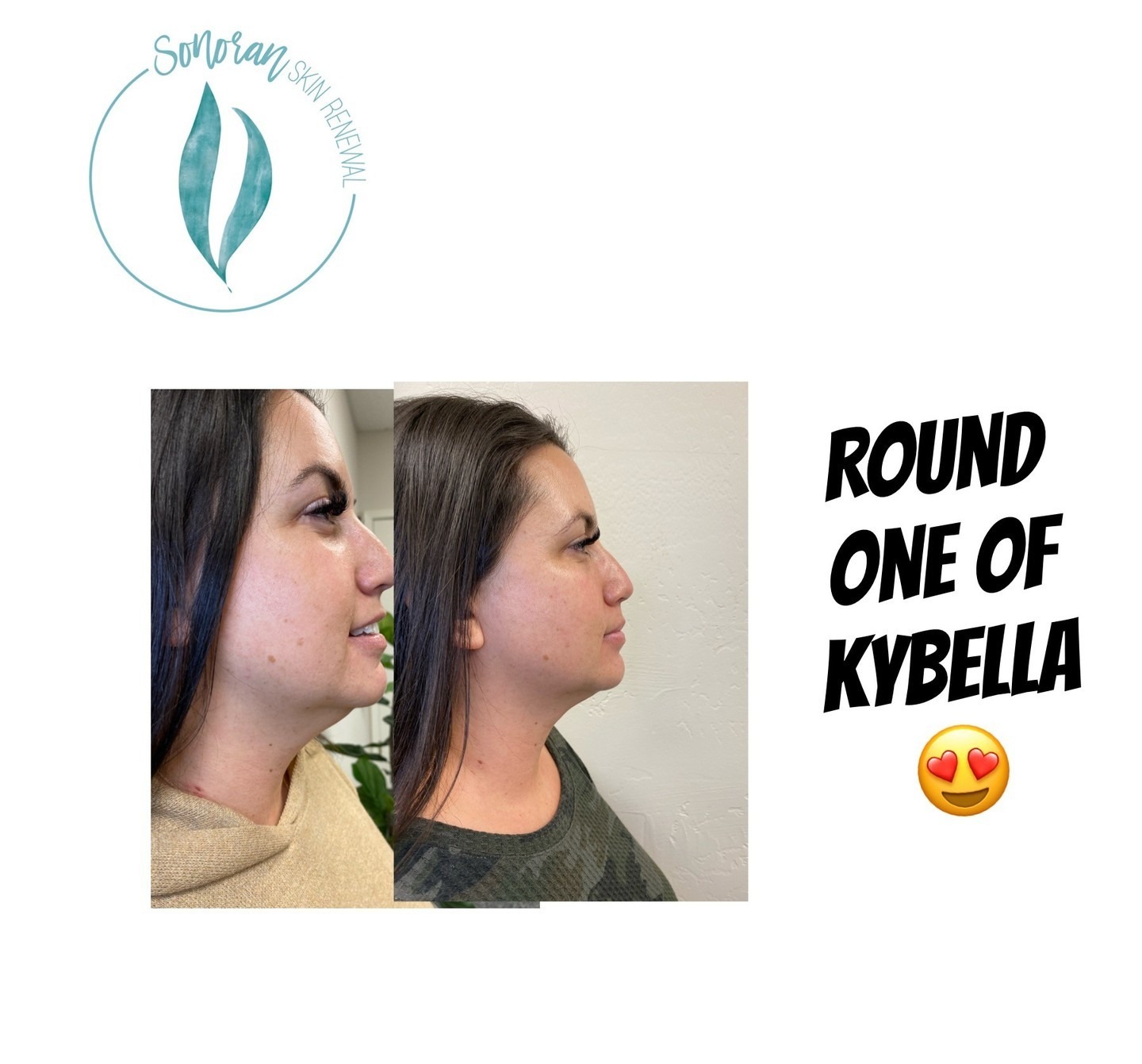 Kybella before and after — reduced submental fullness, sharper jawline — Sonoran Skin Renewal, Scottsdale AZ