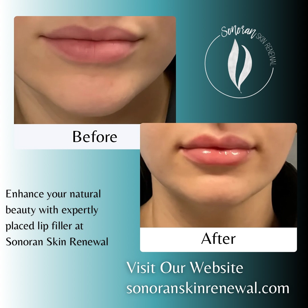 Lip filler before and after — added volume, definition and hydration — Sonoran Skin Renewal, Scottsdale AZ