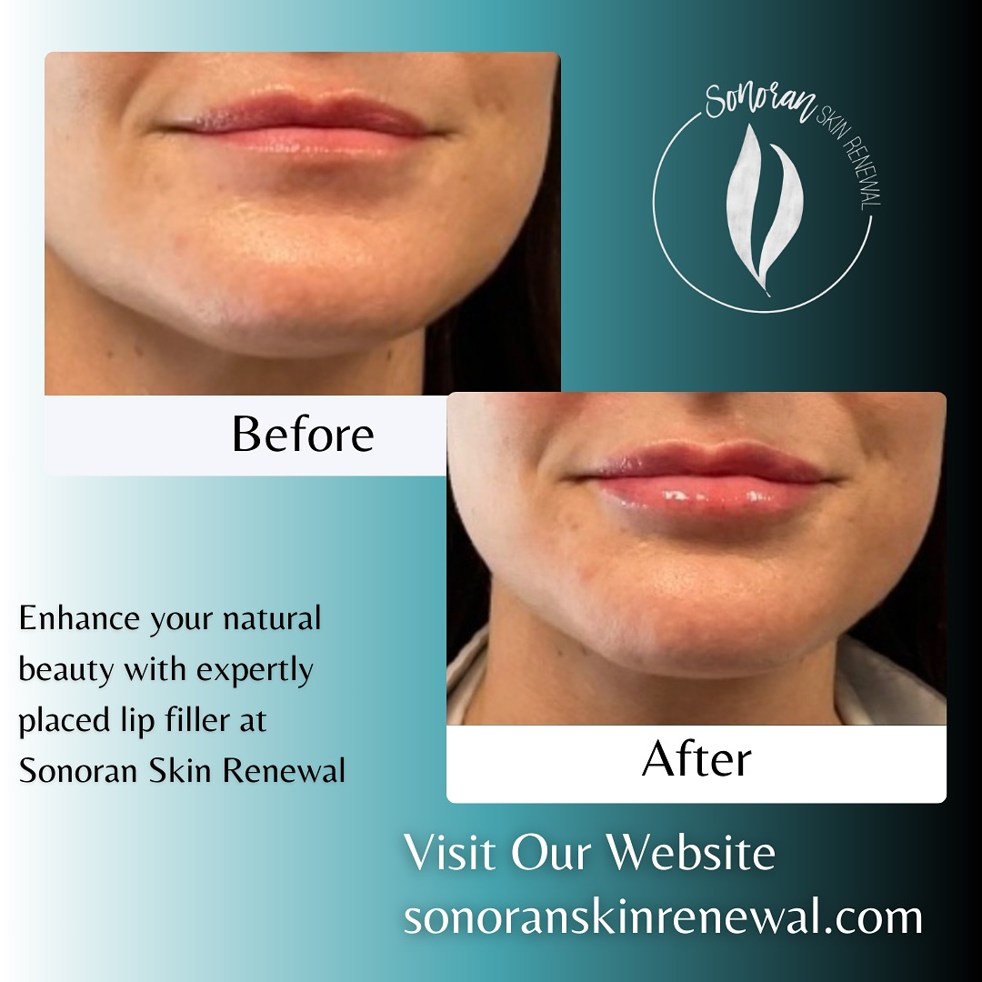 Lip filler before and after — added volume, definition and hydration — Sonoran Skin Renewal, Scottsdale AZ