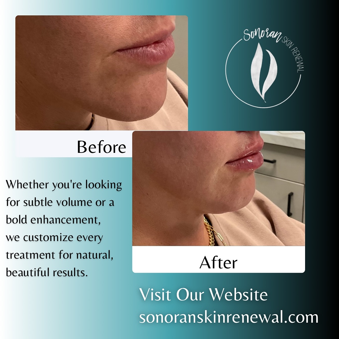 Lip filler before and after — added volume, definition and hydration — Sonoran Skin Renewal, Scottsdale AZ