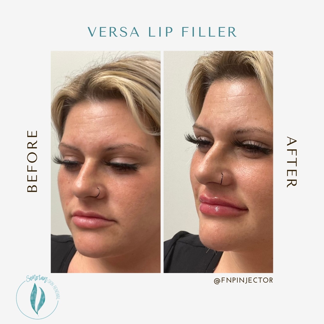 Lip filler before and after — added volume, definition and hydration — Sonoran Skin Renewal, Scottsdale AZ