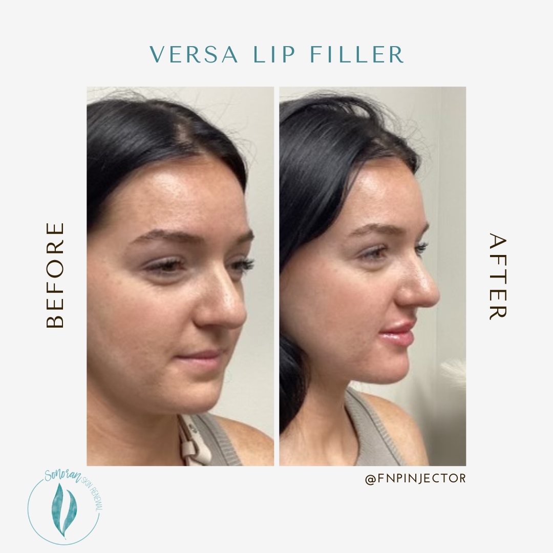 Lip filler before and after — added volume, definition and hydration — Sonoran Skin Renewal, Scottsdale AZ