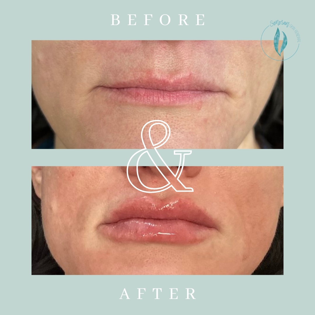 Lip filler before and after — added volume, definition and hydration — Sonoran Skin Renewal, Scottsdale AZ
