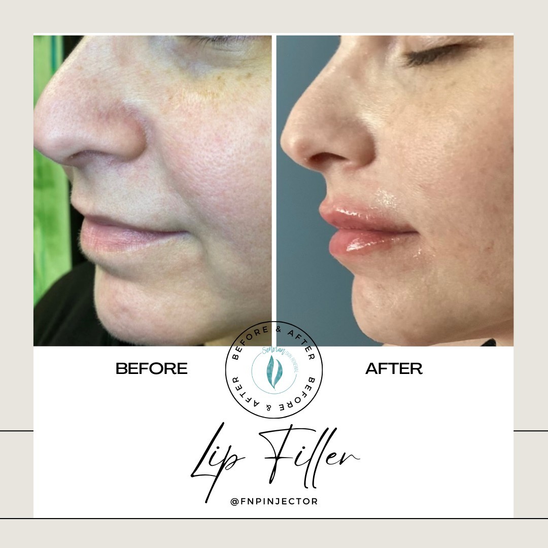 Lip filler before and after — added volume, definition and hydration — Sonoran Skin Renewal, Scottsdale AZ