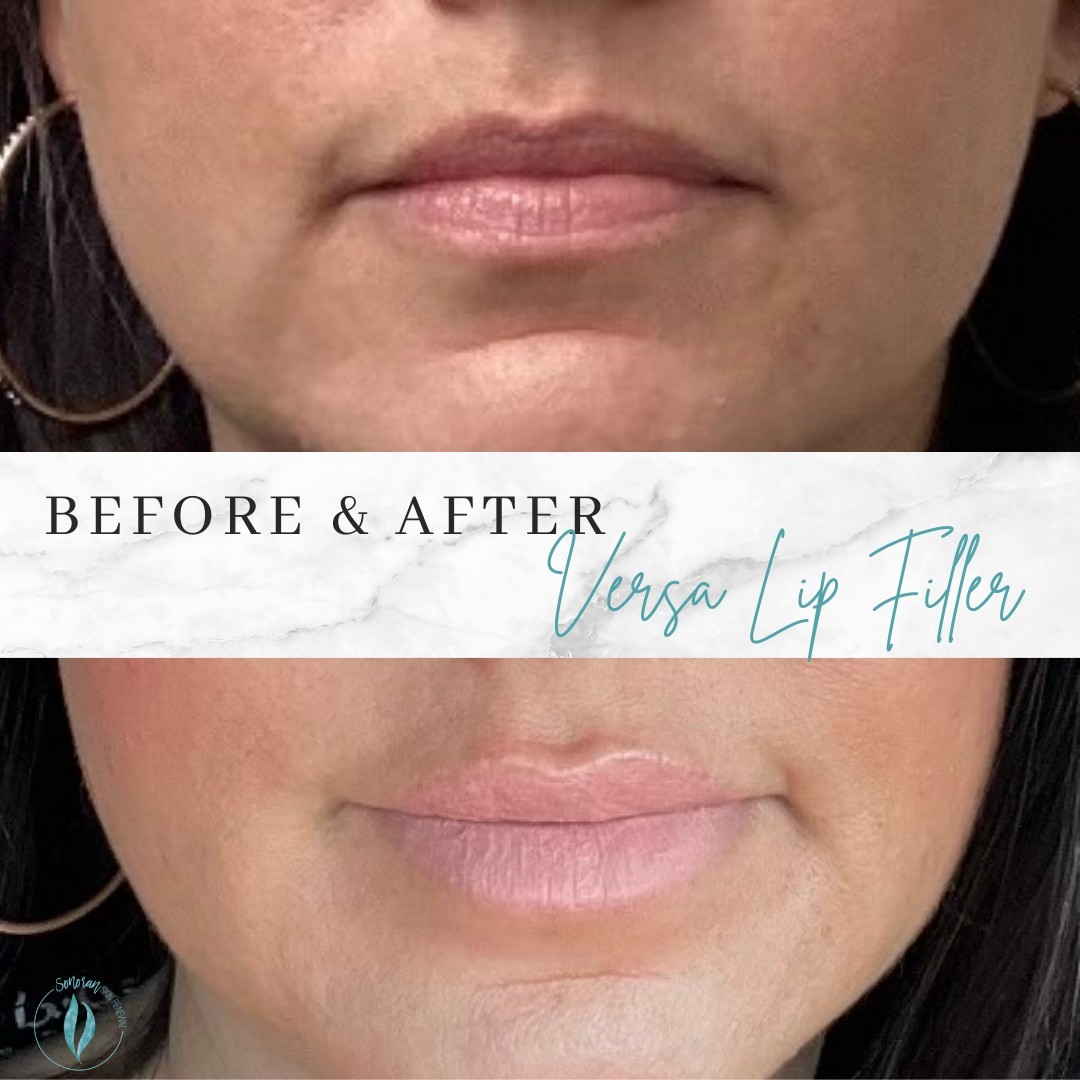 Lip filler before and after — added volume, definition and hydration — Sonoran Skin Renewal, Scottsdale AZ
