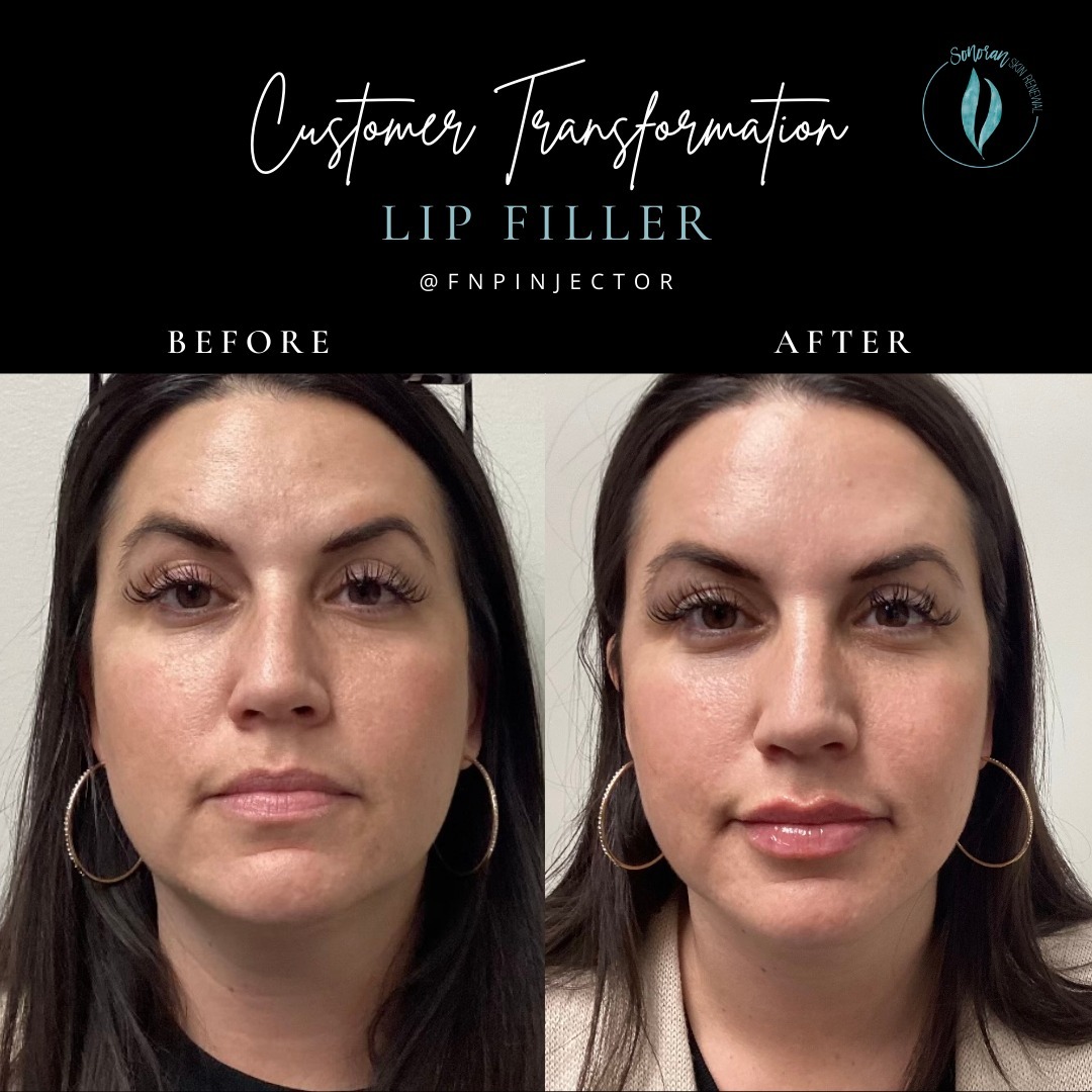 Lip filler before and after — added volume, definition and hydration — Sonoran Skin Renewal, Scottsdale AZ